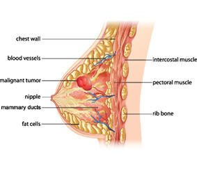 Diagram of the female breast with a cancerous tumour