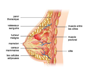 Diagramme du sein de la femme avec une tumeur cancéreuse